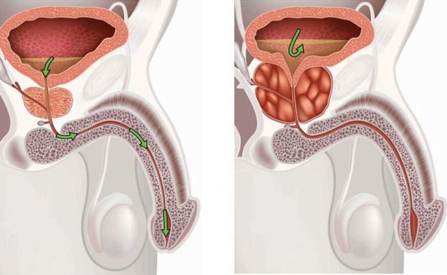 Información sobre la enfermedad prostatitis. 