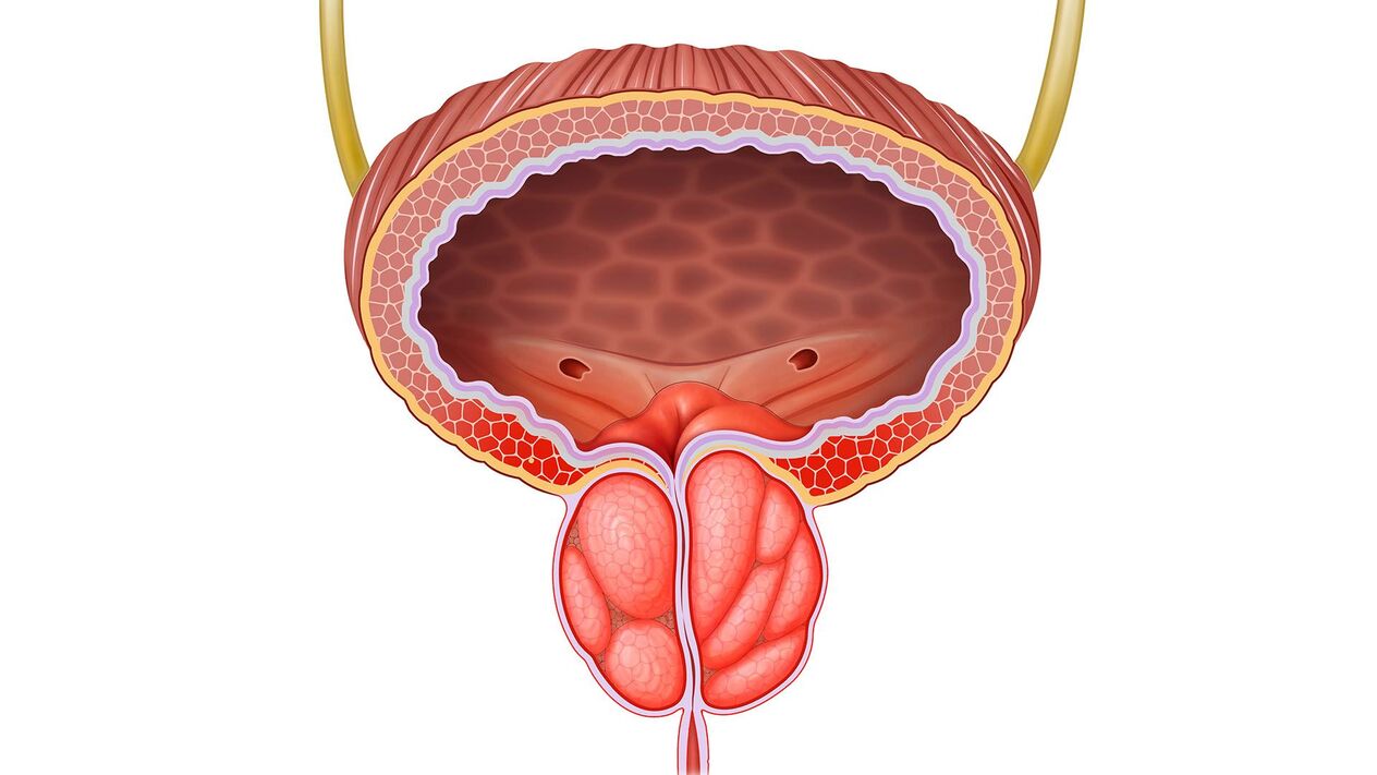 glándula prostática inflamada